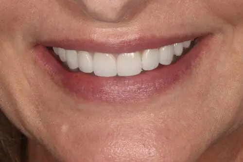 after dentistry at Flax Dental