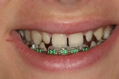 before dentistry at Flax Dental