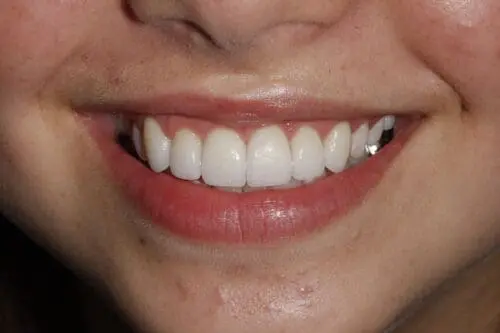 after dentistry at Flax Dental