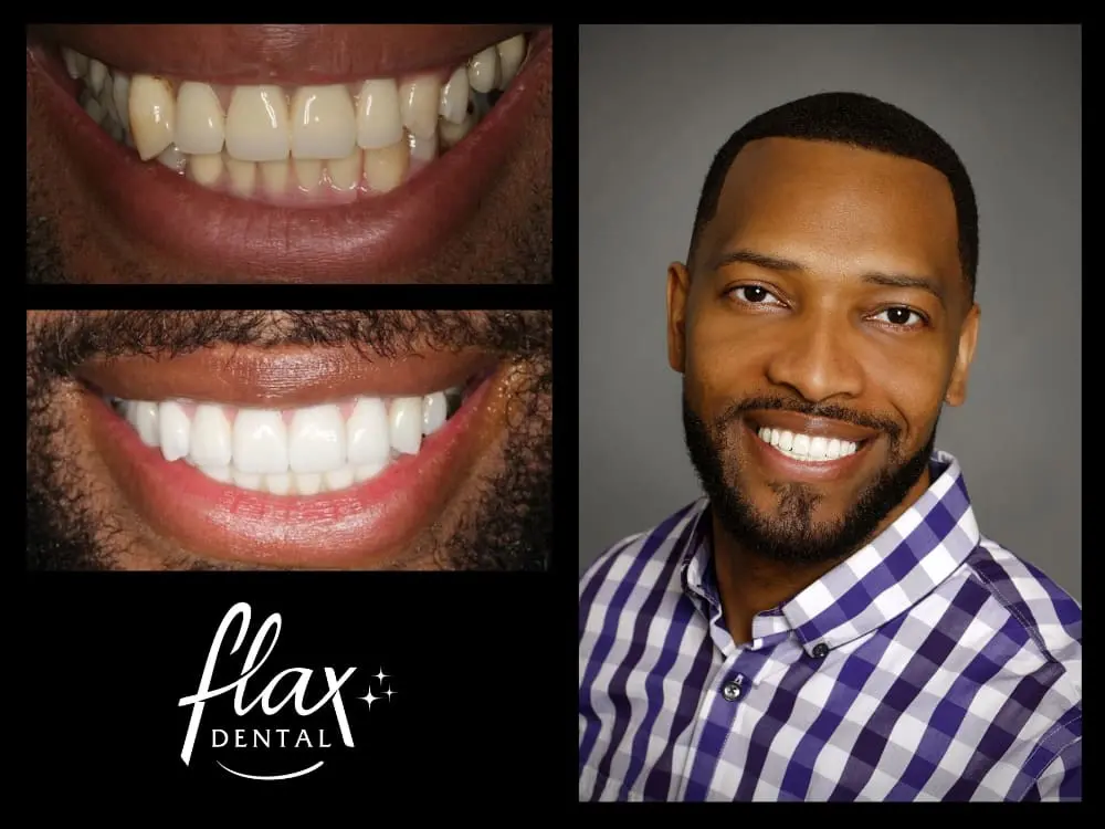 Dental implants results in Sandy Springs, GA