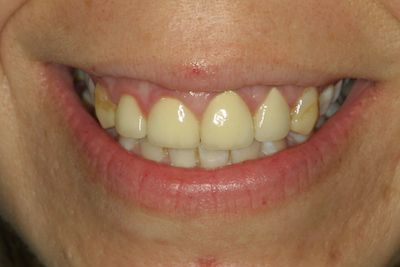 Kim teeth before Flax Dental
