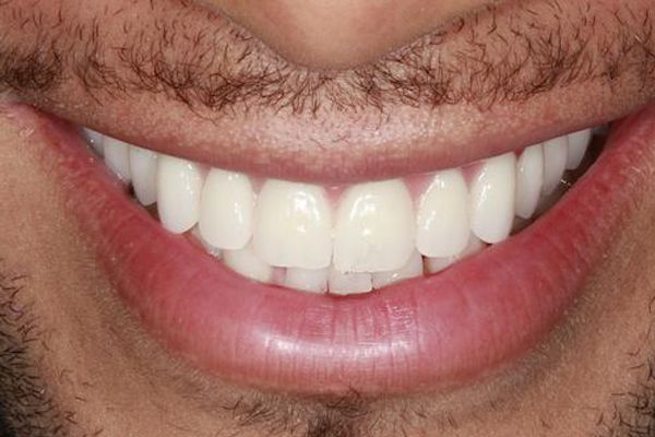 Nasir teeth after Flax Dental