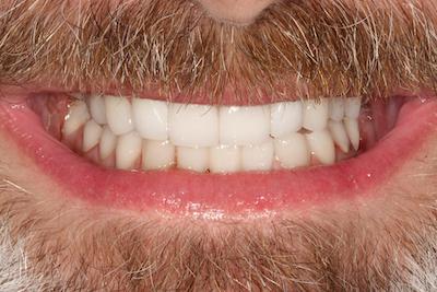 Lee teeth after Flax Dental