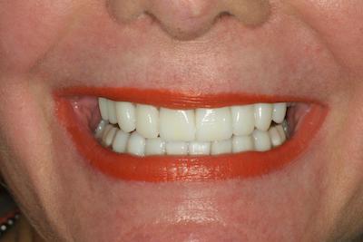Susan teeth after Flax Dental