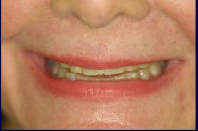 Susan teeth before Flax Dental