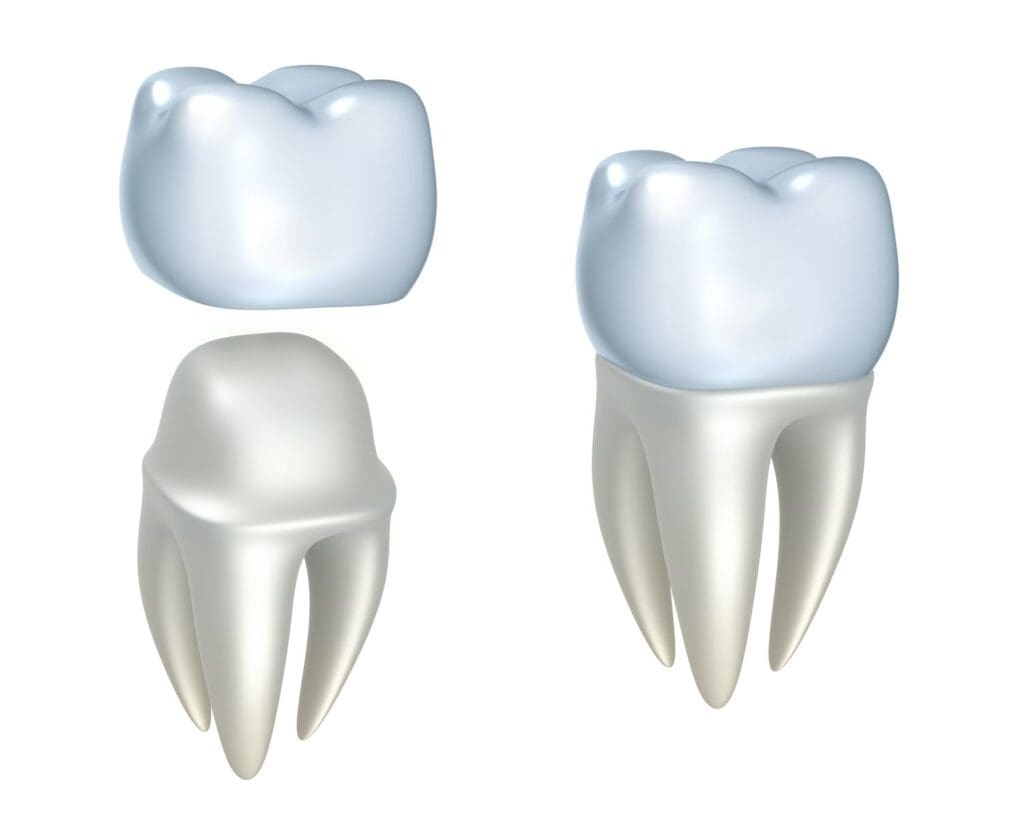 Dental Crown in Sandy Springs, GA