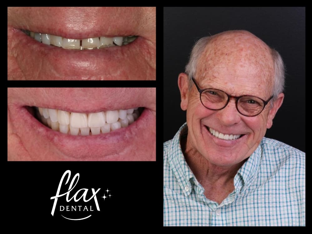 Full-Mouth Reconstruction in Sandy Springs, GA