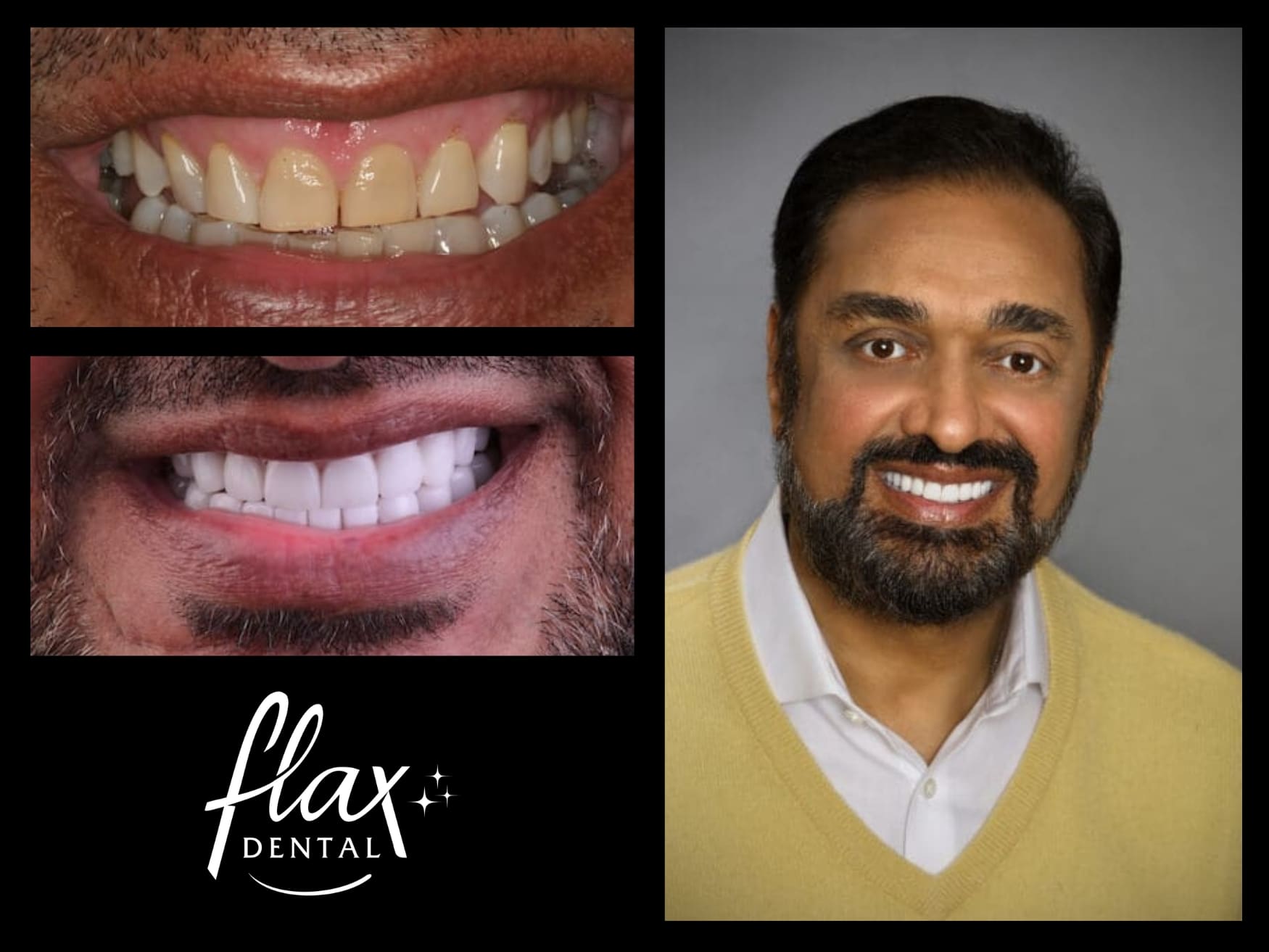 Restorative dentistry results in Sandy Springs, GA