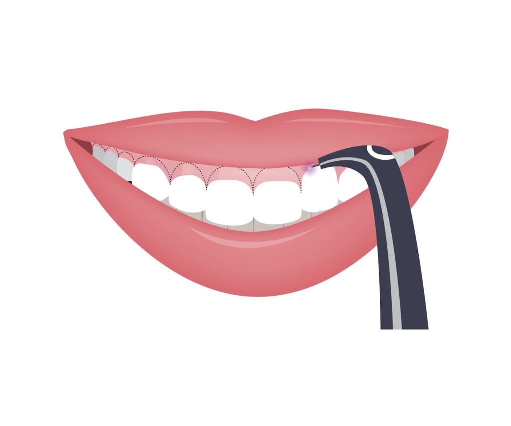 Laser dentistry offers a modern approach to dental care. Dentists use lasers to perform various dental procedures.