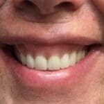 After cosmetic dentistry