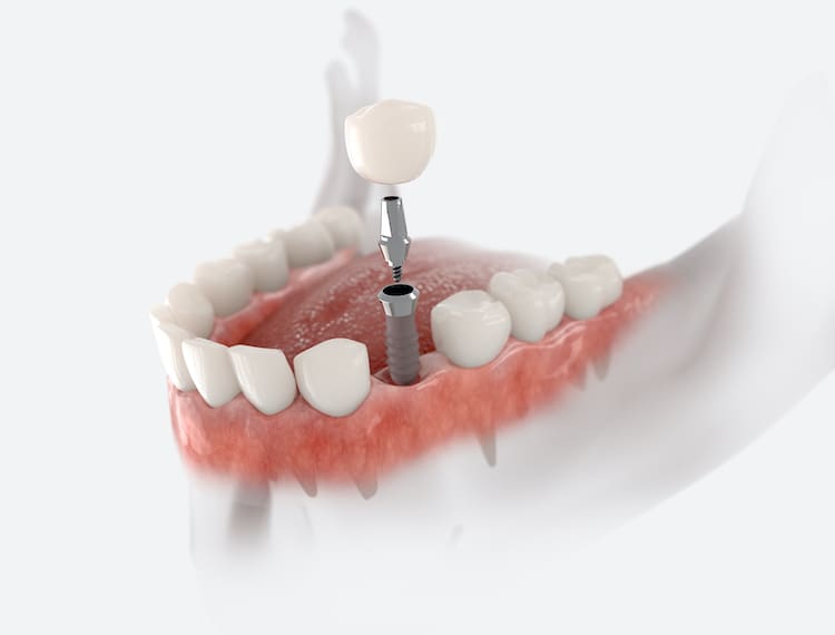 Understanding the benefits of dental implant treatment can help patients make an informed decision about their oral health.