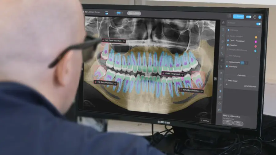 Overjet AI analysis on a digital dental X-ray