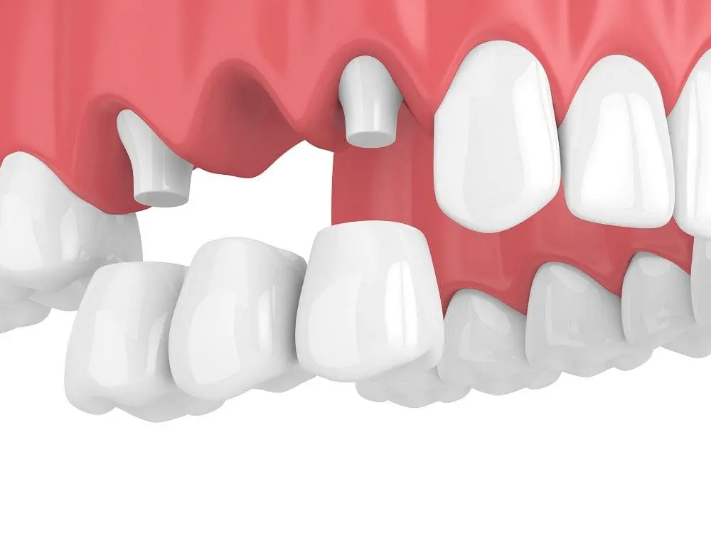 Dental bridges in Sandy Springs, GA