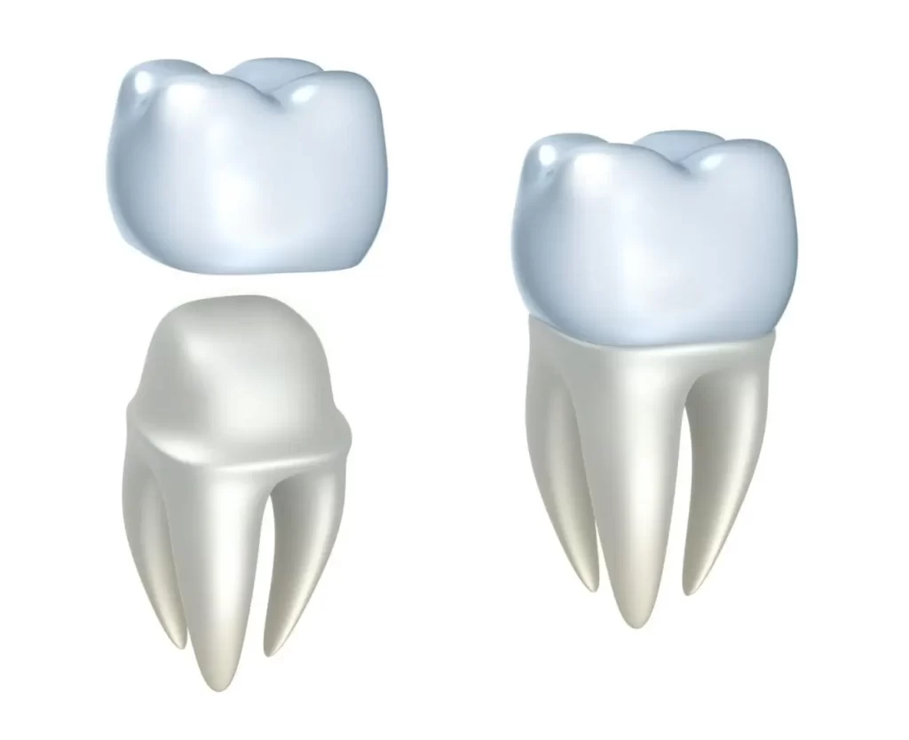 Dental crown in Sandy Springs, GA