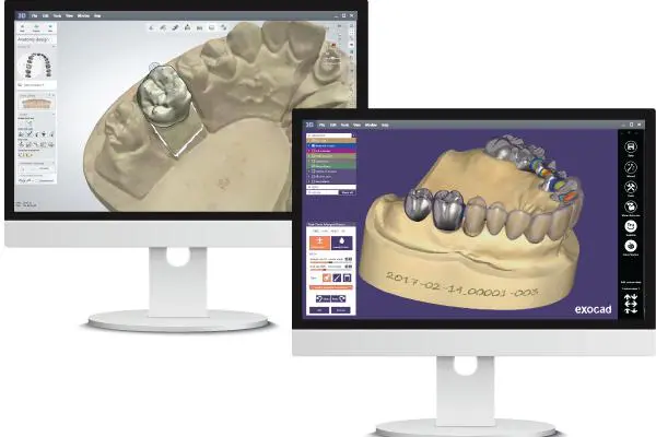 Exocad digital restoration design