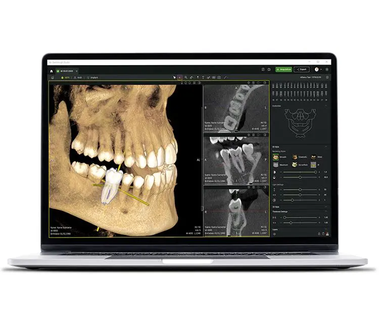 Advanced digital imaging workflow with Exocad