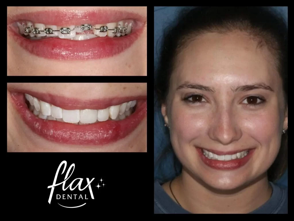 Flaxdental before after Dental Bonding