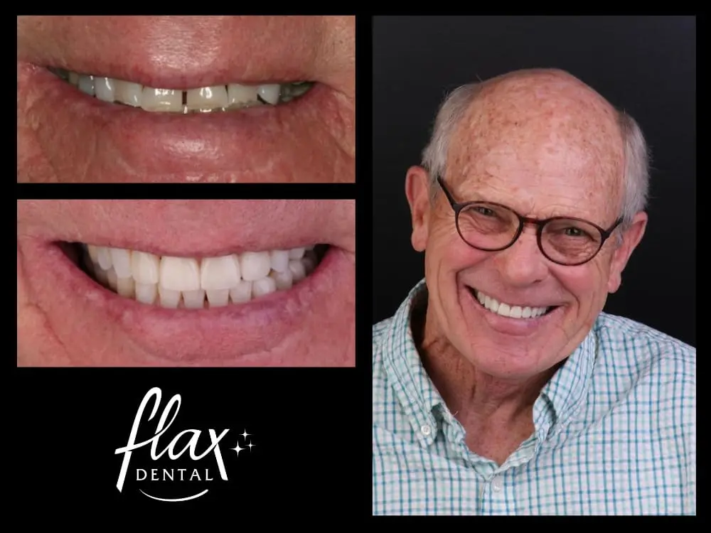 Full-mouth reconstruction in Sandy Springs, GA