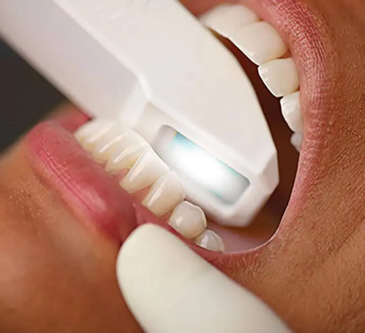 iTero digital scanner