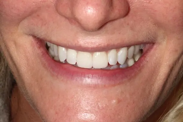 After teeth whitening and veneers at Flax Dental, Atlanta