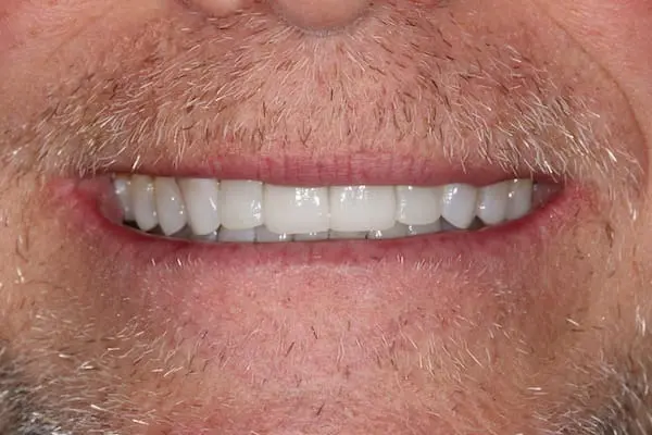After bonding, orthodontics and teeth whitening at Flax Dental, Atlanta
