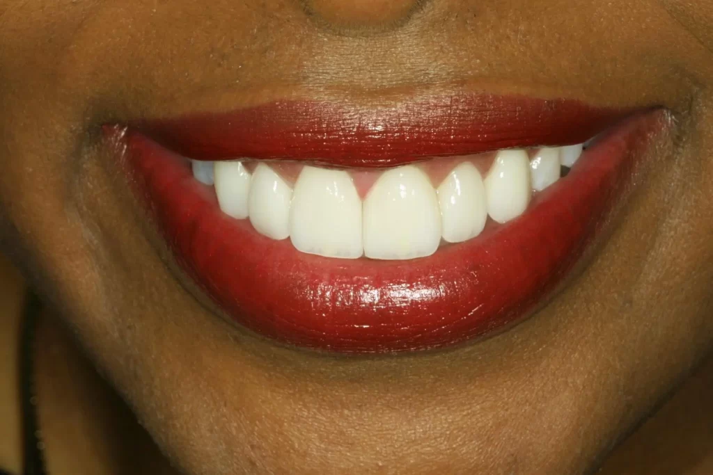 After orthodontics and veneers at Flax Dental, Atlanta