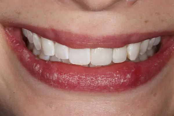 After bonding and orthodontics at Flax Dental, Atlanta