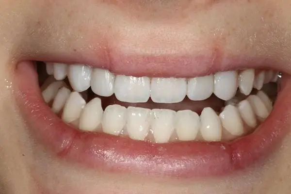 After bonding and teeth whitening at Flax Dental, Atlanta