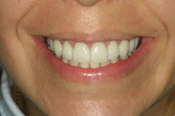 After dental crowns, gum lift and veneers at Flax Dental, Atlanta