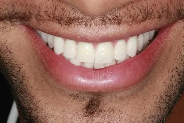 After dental implants at Flax Dental, Atlanta