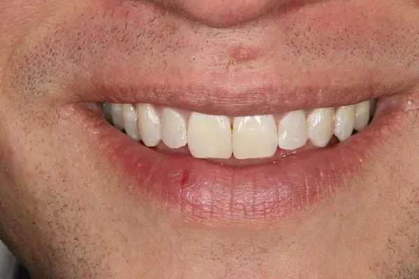 After preventative dentistry at Flax Dental, Atlanta