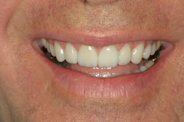 After veneers at Flax Dental, Atlanta