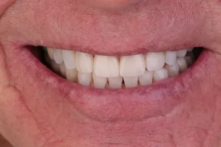 After smile makeover at Flax Dental, Atlanta