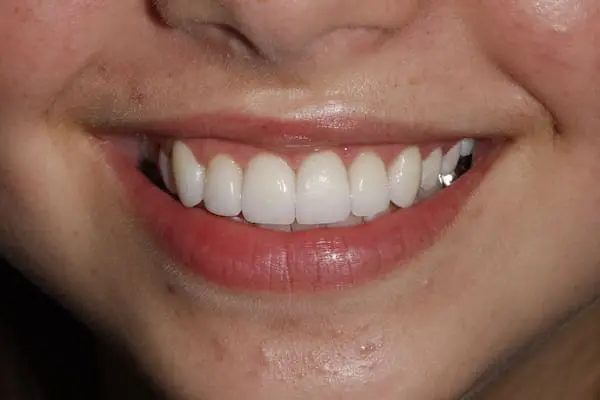 After smile makeover and veneers at Flax Dental, Atlanta