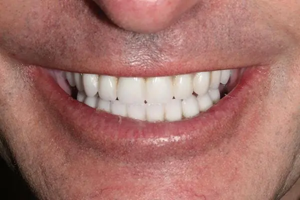 After dental implants at Flax Dental, Atlanta