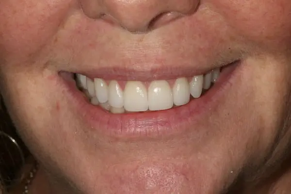After orthodontics and veneers at Flax Dental, Atlanta