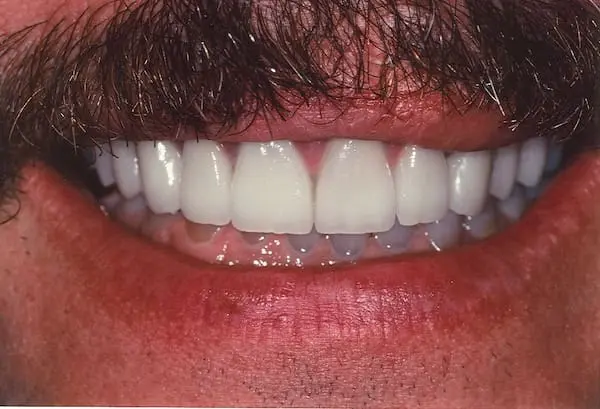 After smile makeover at Flax Dental, Atlanta