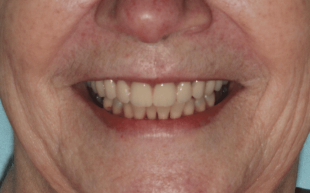 After smile makeover at Flax Dental, Atlanta