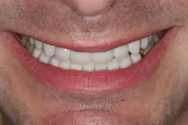 After gum lift, orthodontics and veneers at Flax Dental, Atlanta