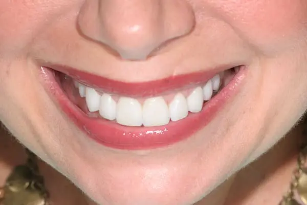 After cosmetic dentistry at Flax Dental, Atlanta