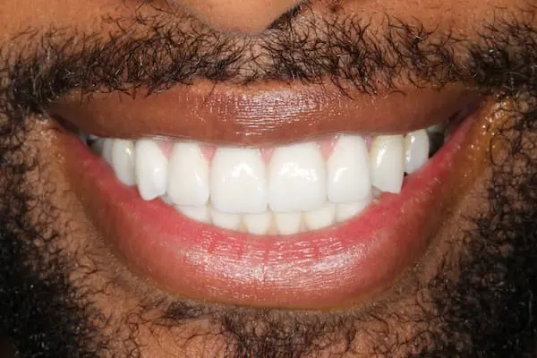 After cosmetic dentistry at Flax Dental, Atlanta