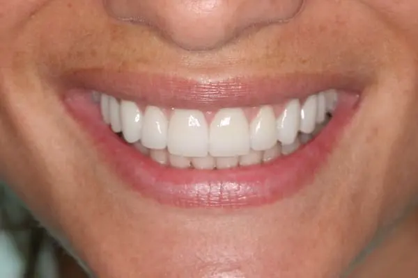 After gum lift and veneers at Flax Dental, Atlanta