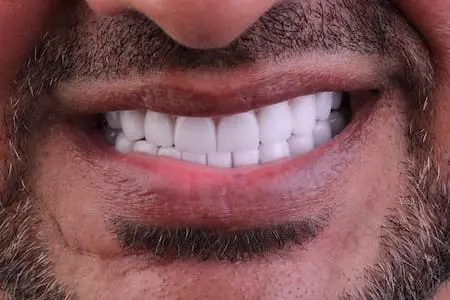 After cosmetic dentistry at Flax Dental, Atlanta