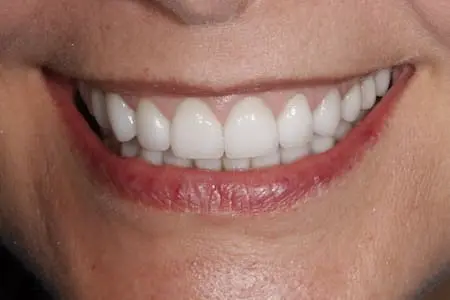 After cosmetic dentistry at Flax Dental, Atlanta