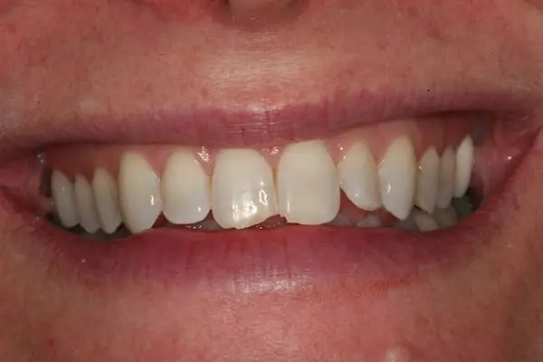 Before teeth whitening and veneers at Flax Dental, Atlanta