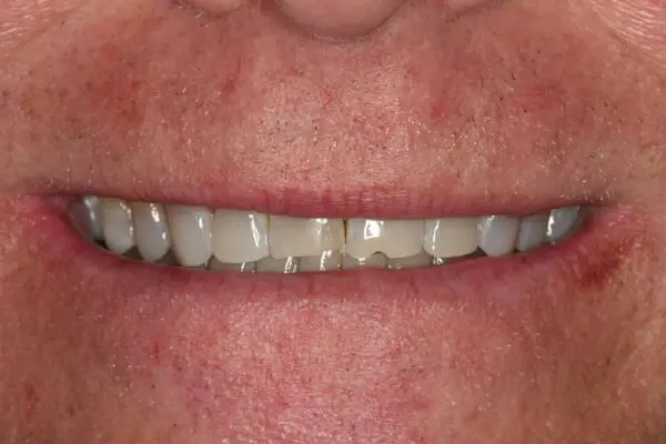 Before bonding, orthodontics and teeth whitening at Flax Dental, Atlanta