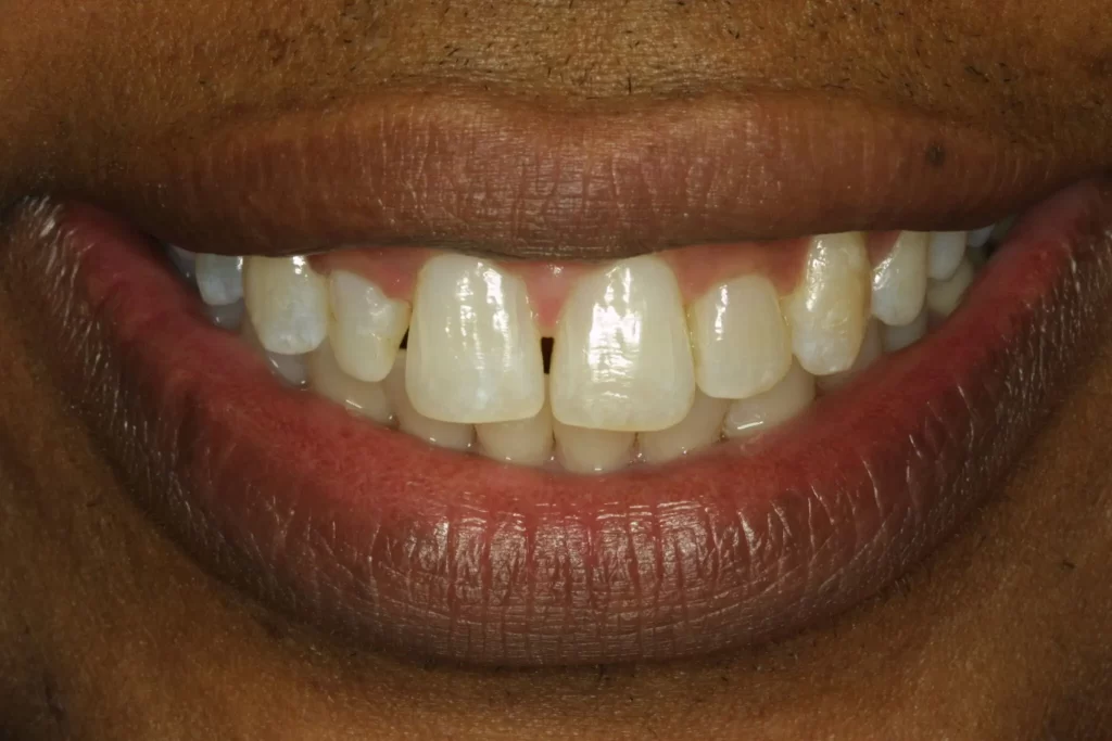 Before orthodontics and veneers at Flax Dental, Atlanta