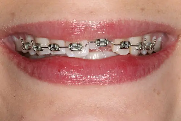 Before bonding and orthodontics at Flax Dental, Atlanta