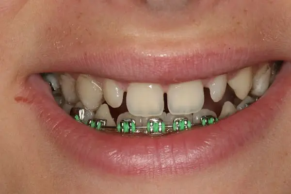 Before bonding and teeth whitening at Flax Dental, Atlanta
