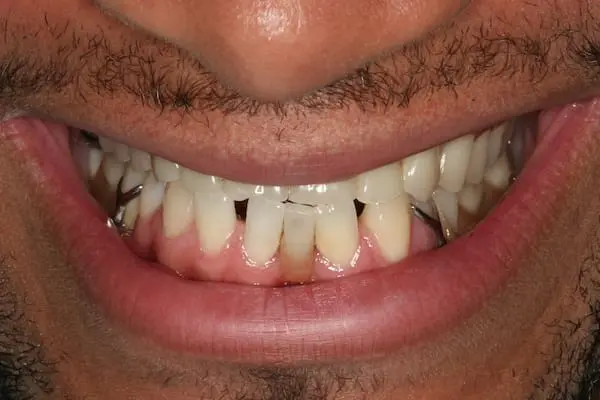 Before dental implants at Flax Dental, Atlanta